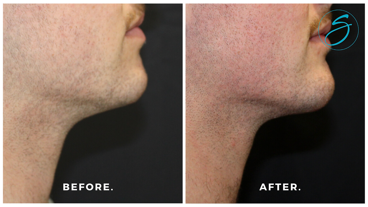 Chin & Jawline Filler - Chin/jawline filler by Dr. Seal