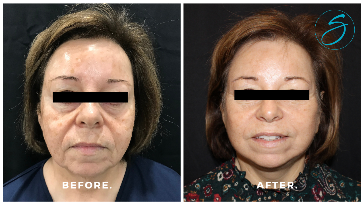 Face & Neck Lift - Face/neck lift by Dr. Seal