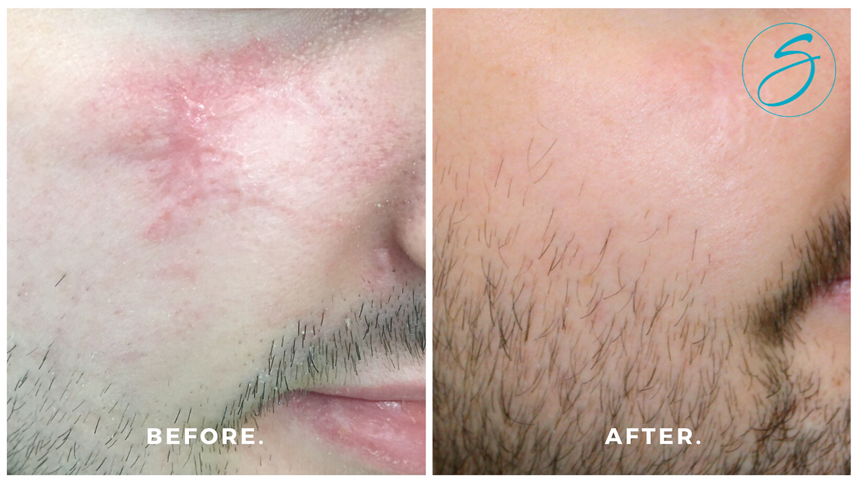 Scar Treatment - Before & after scar treatment by Bernetta