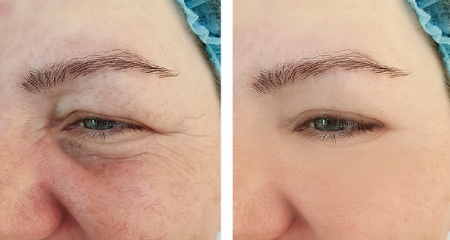 Rosacea - Before & after rosacea treatment