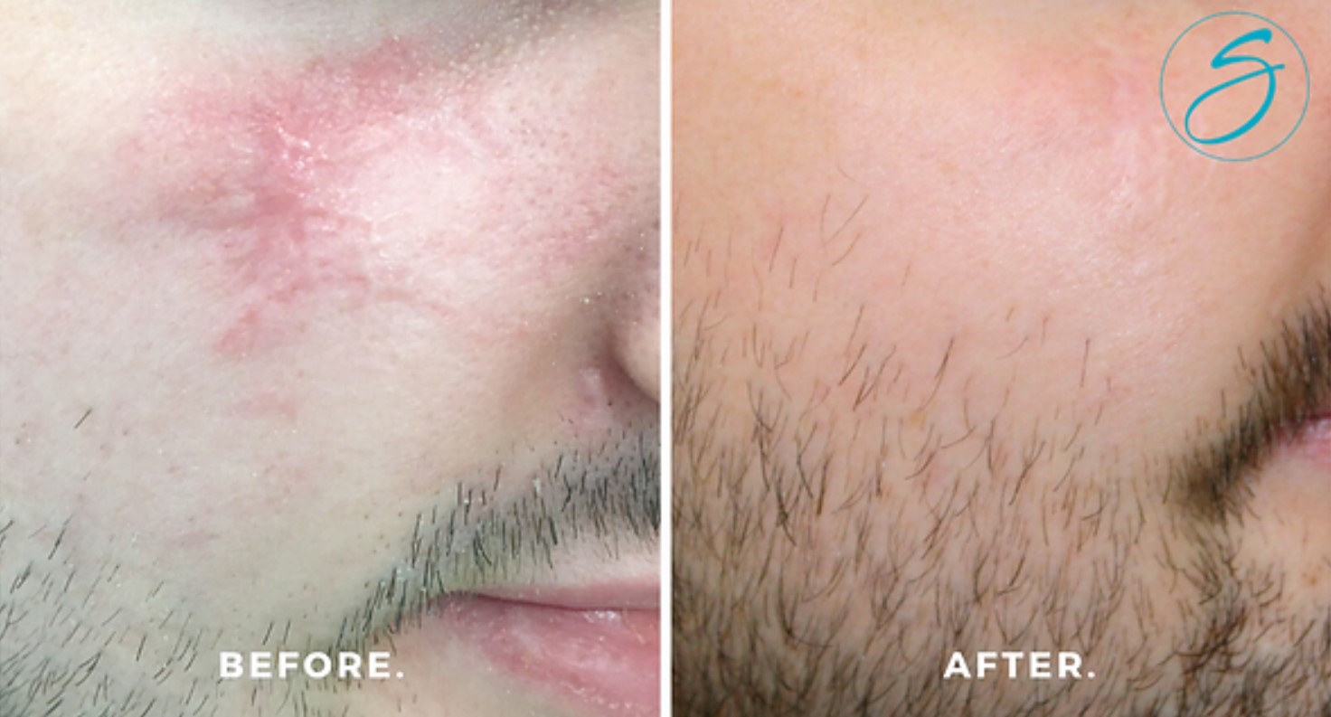 Scar Treatment - Before & after scar treatment by Bernetta