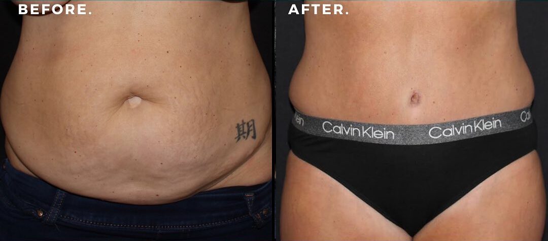 Before & after abdominoplasty by Dr. Seal