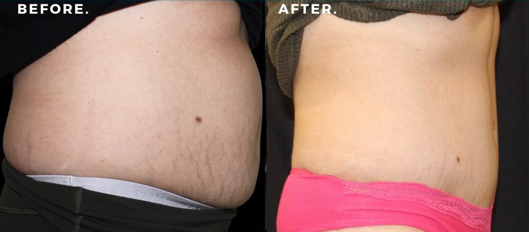 Before & after abdominoplasty by Dr. Seal