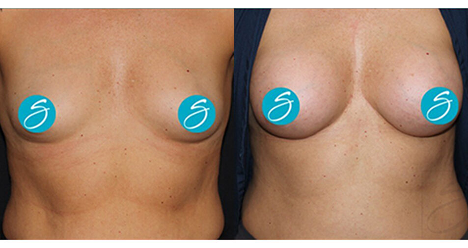 Breast Augmentation - BBA by Dr. Seal