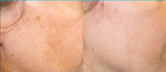 Vivier chemical peels - Before & after