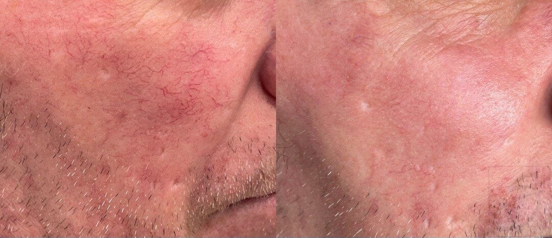 Rosacea - Before & after rosacea treatment