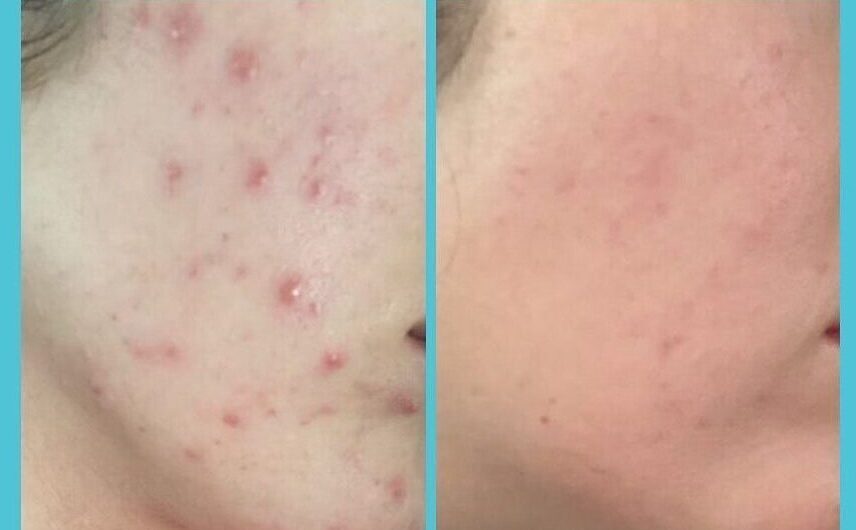 Jessner chemical peels - Before & after