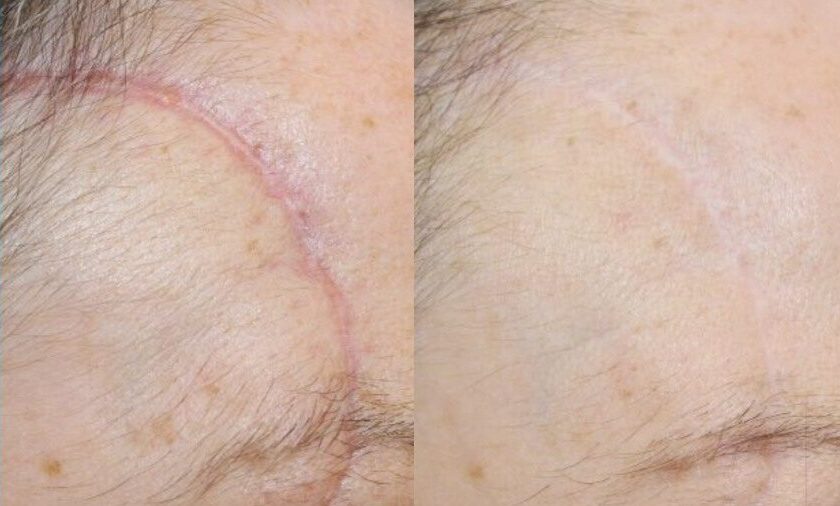 Scar Treatment - Before & after scar treatment