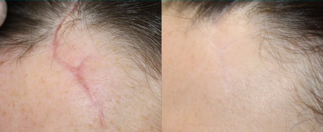 Scar Treatment - Before & after scar treatment
