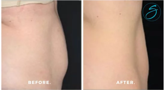 SculpSure - Before & after SculpSure on abdomen
