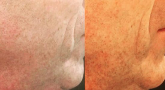 Sculpsure - Before & after SculpSure under chin